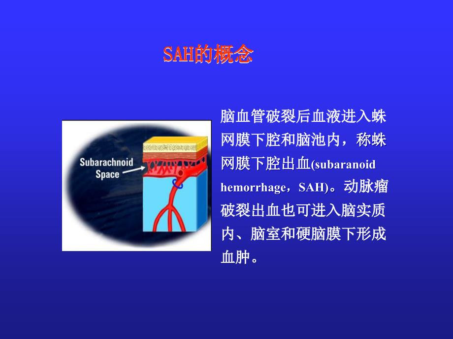 自发性蛛网膜下腔出血诊治流程及规范_第3页