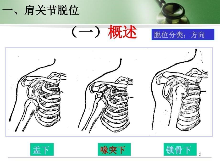 （优质课件）肩关节脱位_第5页