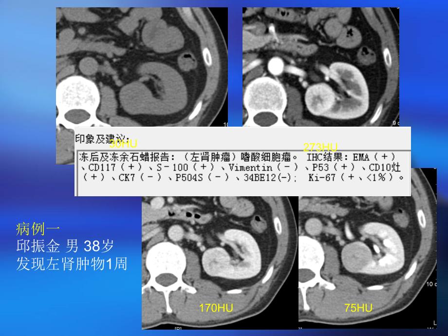 肾细胞癌的ct诊断ppt课件_第2页