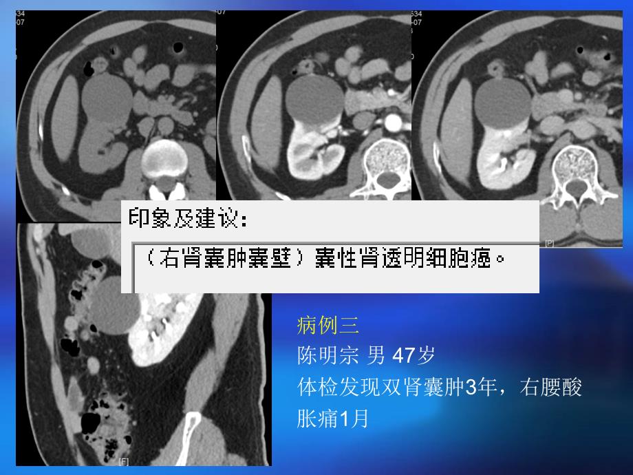 肾细胞癌的ct诊断ppt课件_第4页