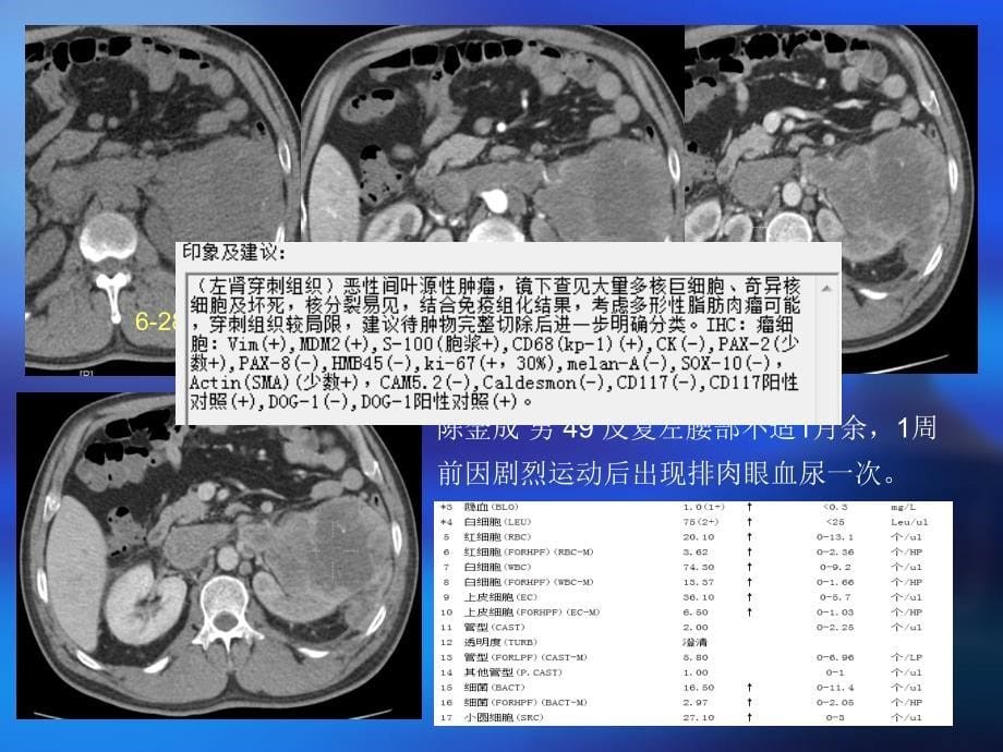 肾细胞癌的ct诊断ppt课件_第5页