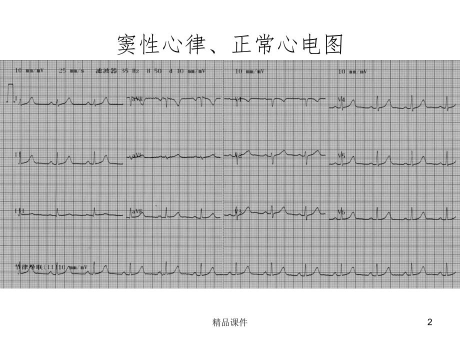 常见典型心电图诊断-规培课件_第2页