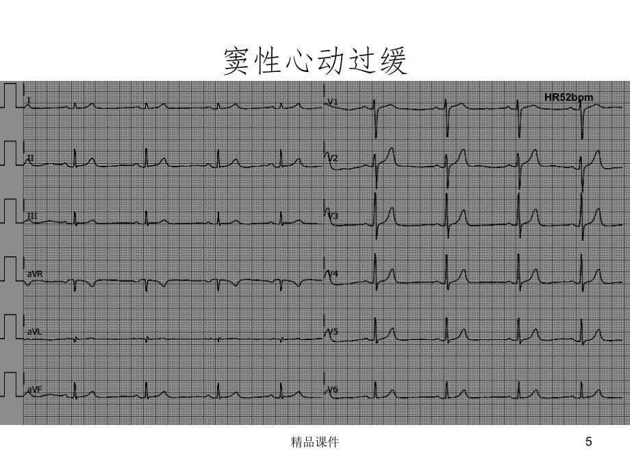 常见典型心电图诊断-规培课件_第5页