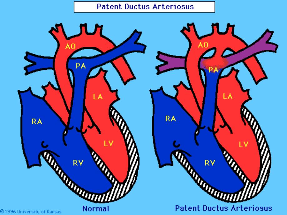 动脉导管未闭PDA_第3页