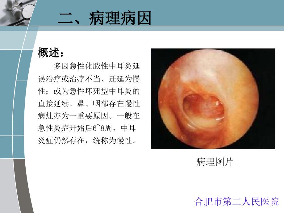 慢性化脓性中耳炎qq_第2页