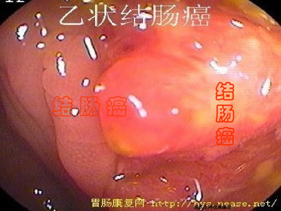 结肠癌结肠癌PPT课件_第1页