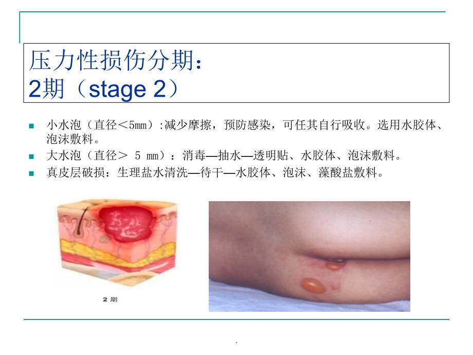 压力性损伤与失禁相关性皮炎ppt课件_第4页