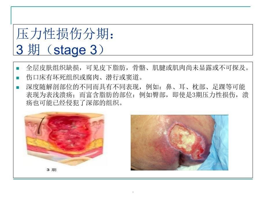 压力性损伤与失禁相关性皮炎ppt课件_第5页