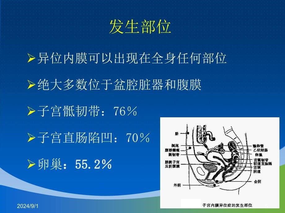 子宫内膜异位症ppt_第5页