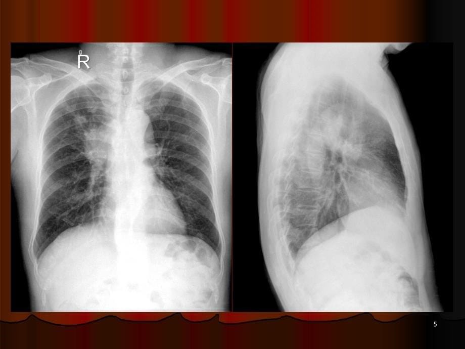 肺门与肺纹理的改变PPT幻灯片_第5页
