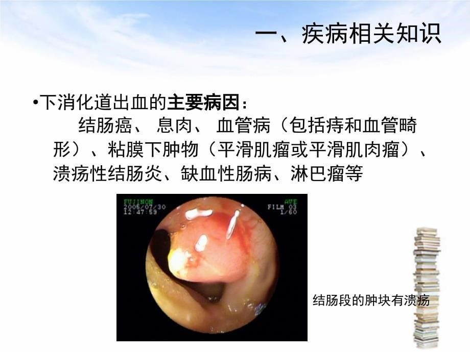 下消化道出血伴失血性休克护理查房ppt课件_第5页