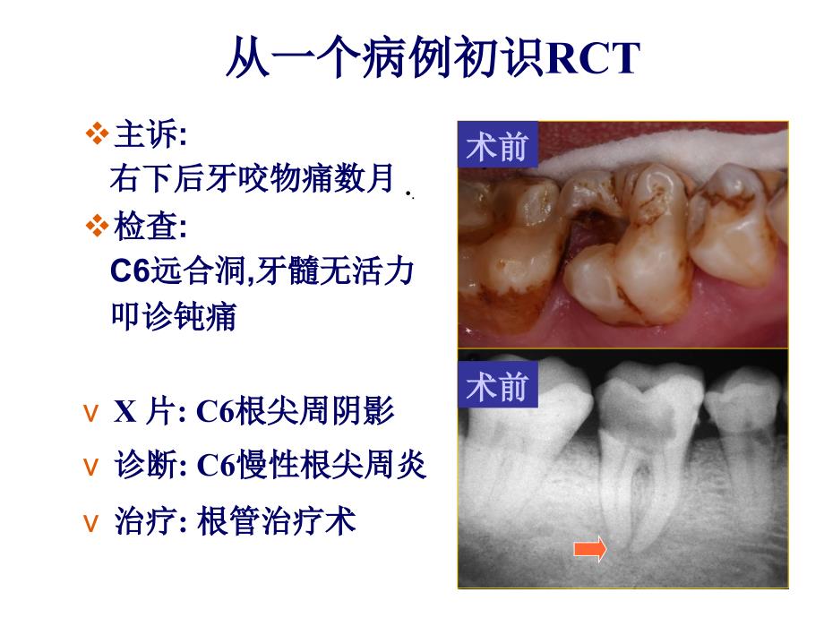 根管治疗的步骤方法器械4课件_第4页