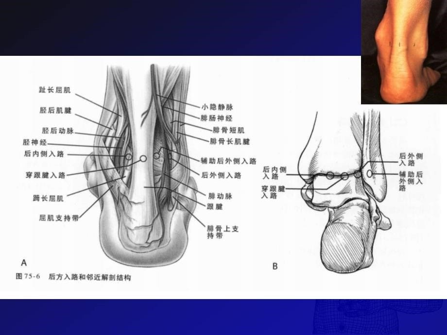 踝关节镜技术PPT课件_第5页