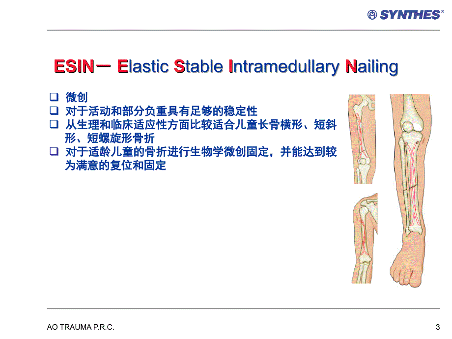 弹力钉的应用ppt课件_第3页