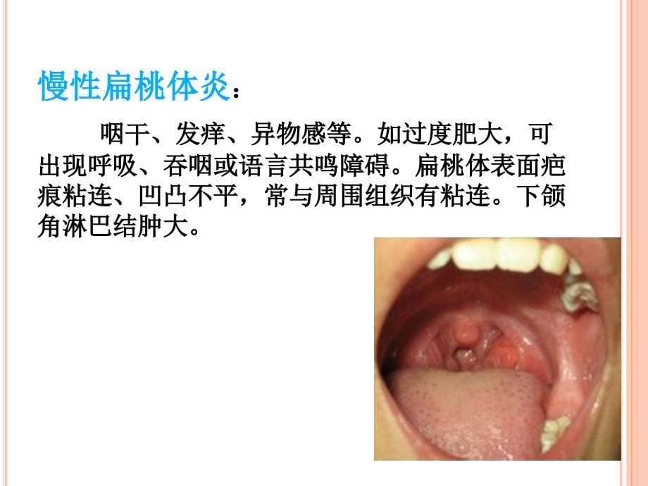 扁桃体炎PPT课件_第5页