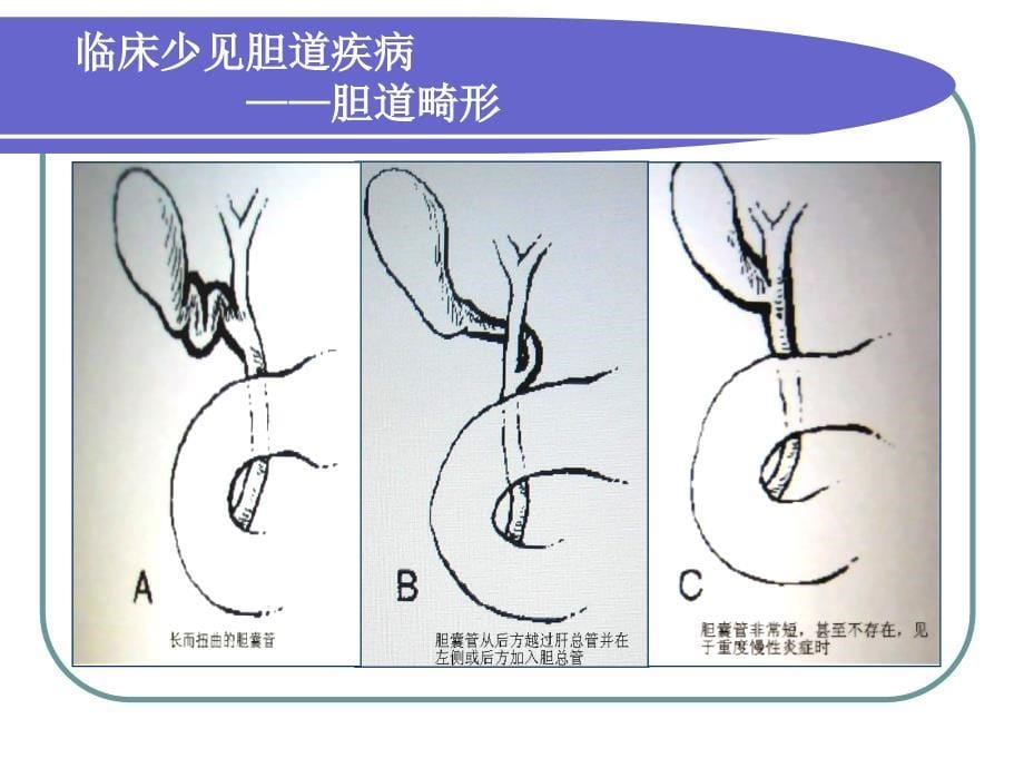 普外科课件资料：胆 道 系 统 疾 病_第5页