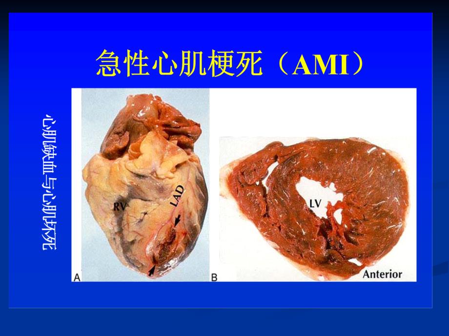 急性心梗的诊治(中西)_第2页