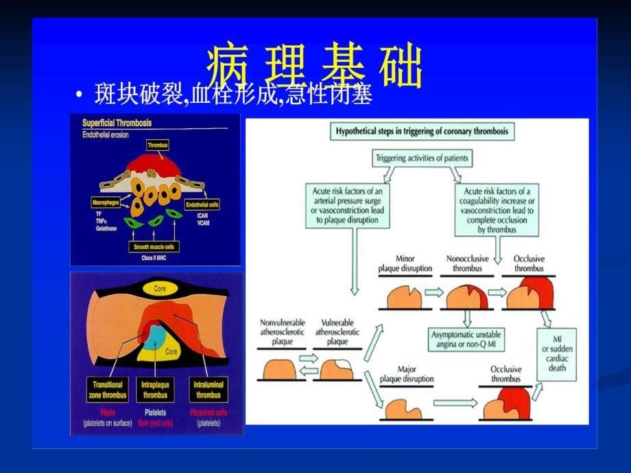 急性心梗的诊治(中西)_第5页