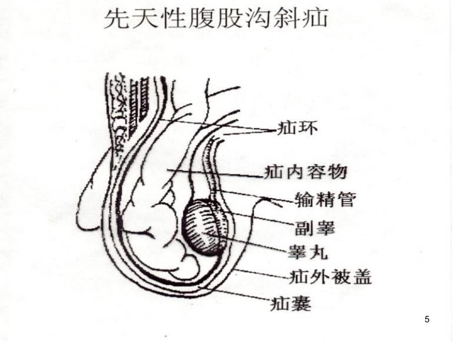 疝气护理常规及分级护理标准ppt参考课件_第5页