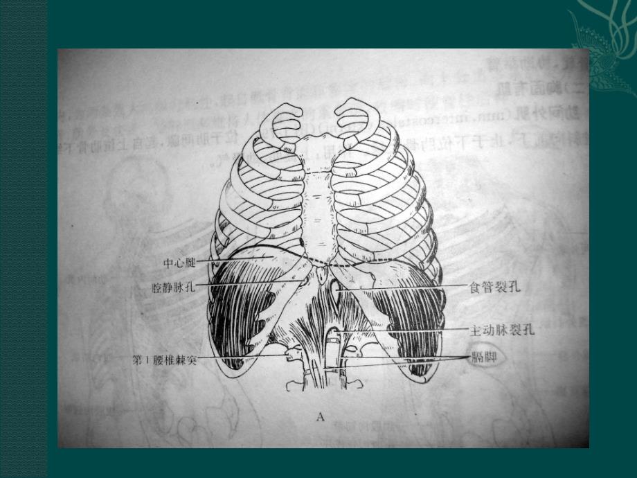 膈疝的影像诊断_第3页