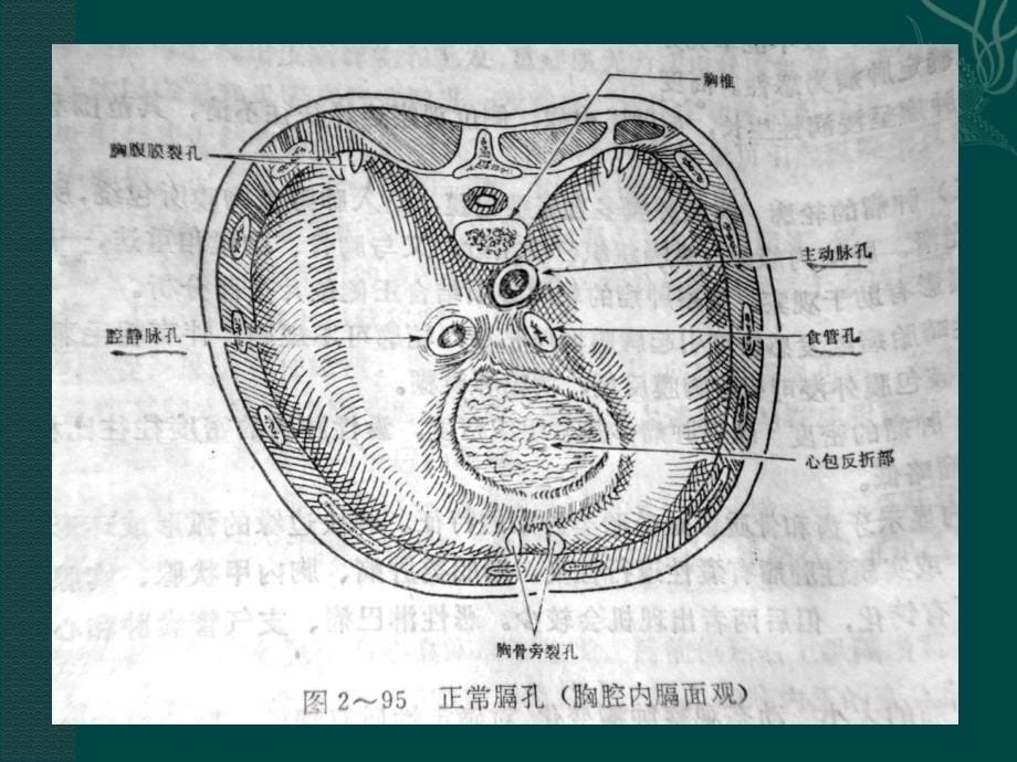 膈疝的影像诊断_第5页