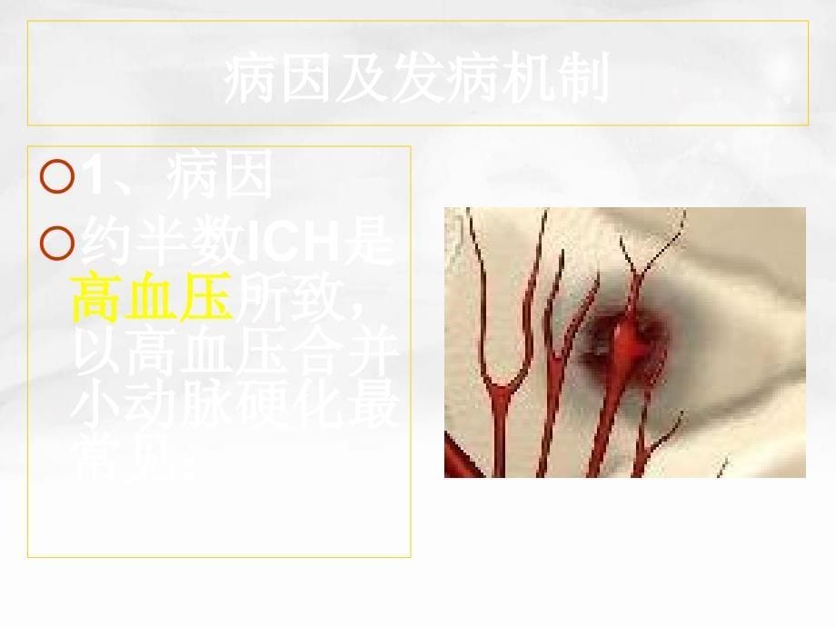 常见疾病病因与治疗方法脑出血2_第5页