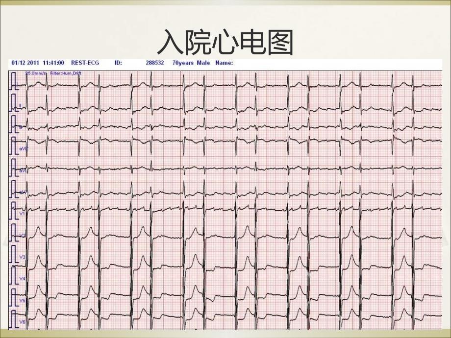 房扑伴房室交界区双层阻滞1例_第3页