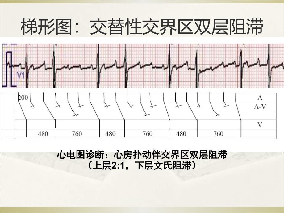 房扑伴房室交界区双层阻滞1例_第4页