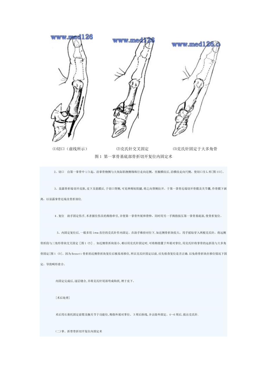 掌骨指骨骨折治疗手术切开复位内固定术_第2页