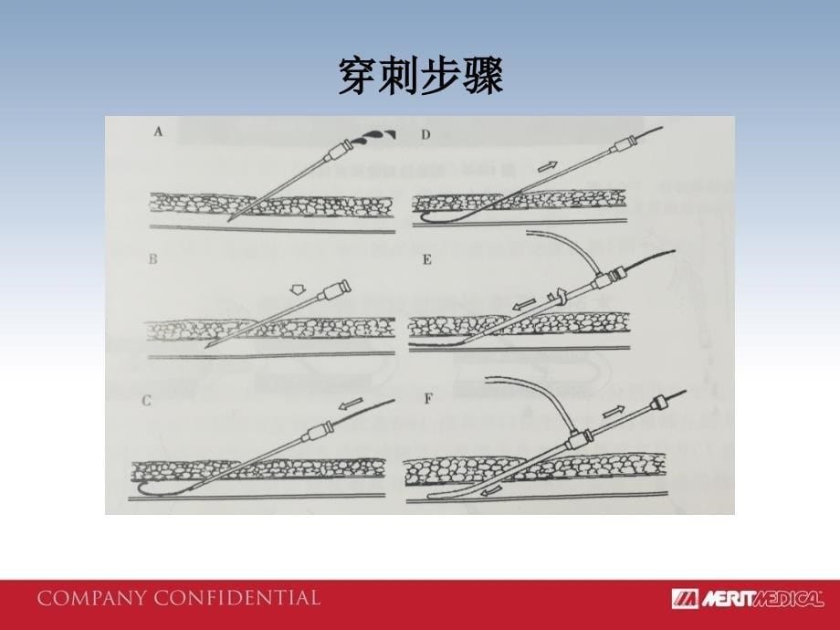 医疗IC产品培训：1.Advance穿刺针_第5页