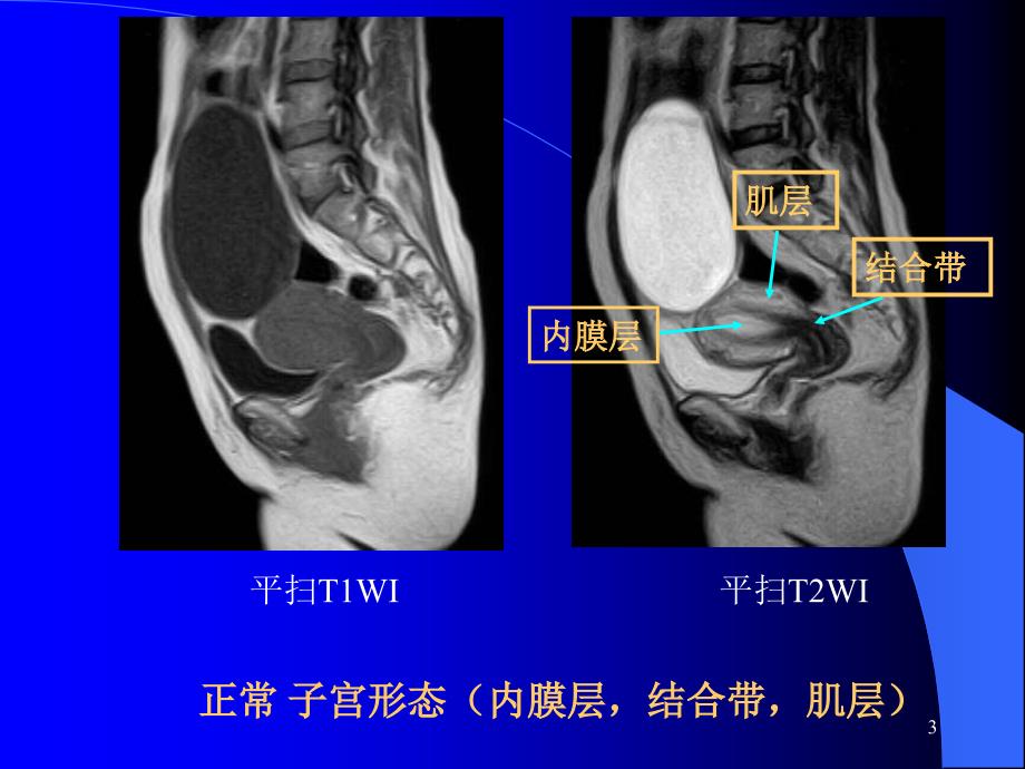 盆腔疾病的MR诊断PPT演示课件_第3页