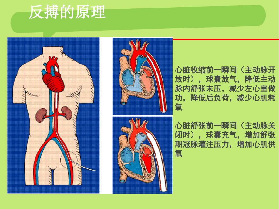 IABP护理查房_第4页