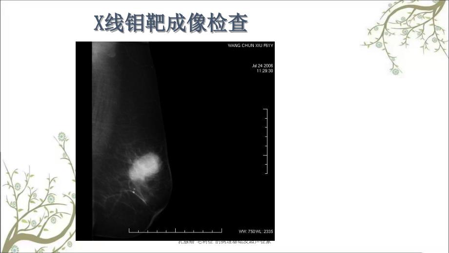 乳腺癌毛刺征的病理基础及超声征象_第4页