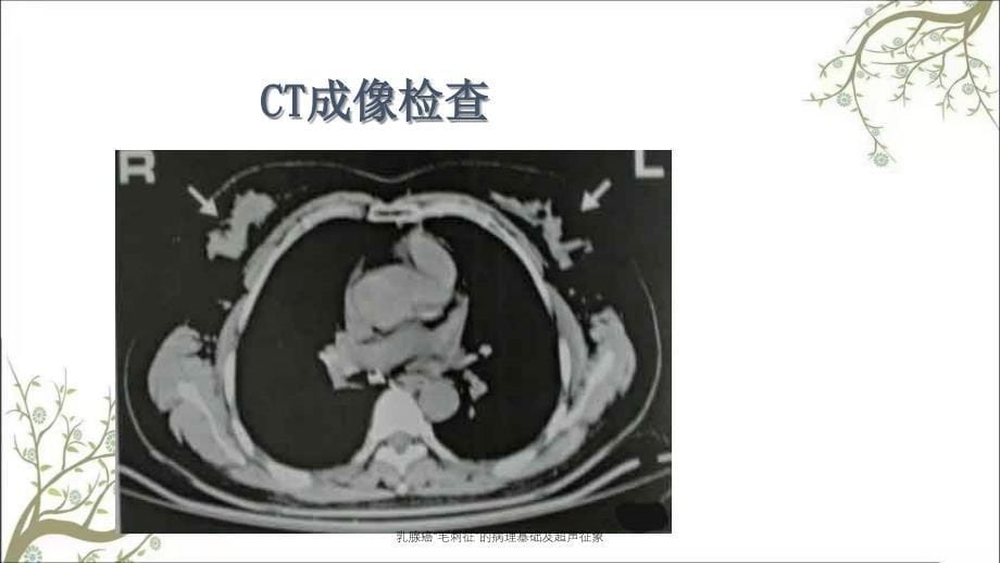 乳腺癌毛刺征的病理基础及超声征象_第5页