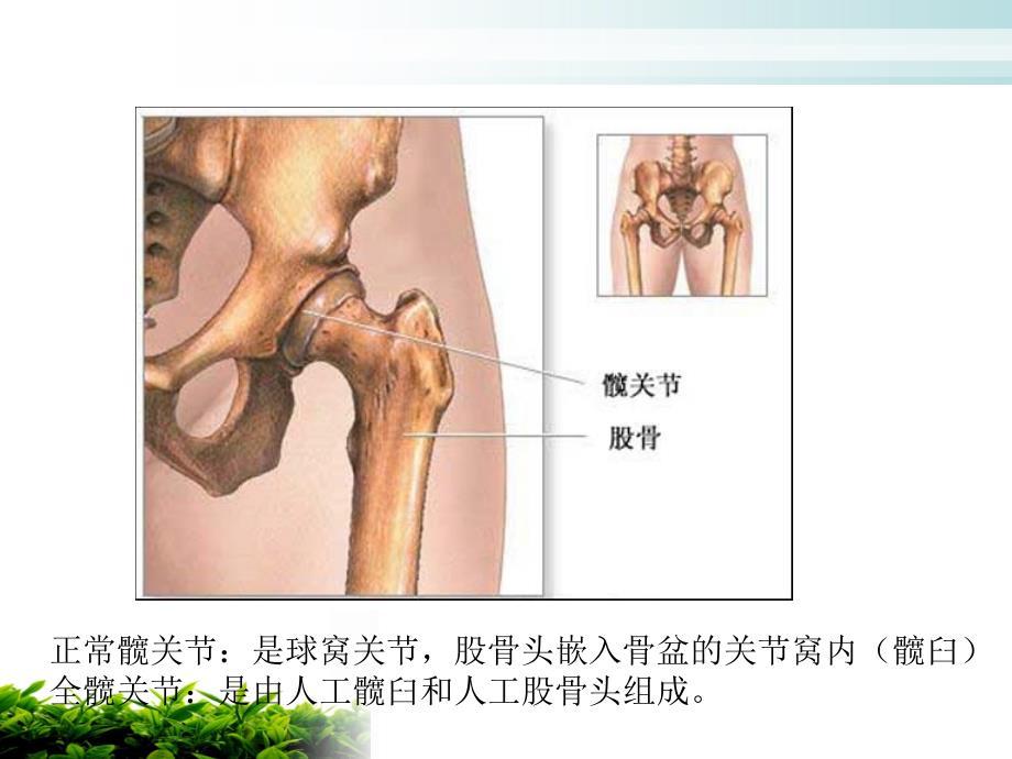 全髋关节置换术后的护理课件PPT演示_第3页