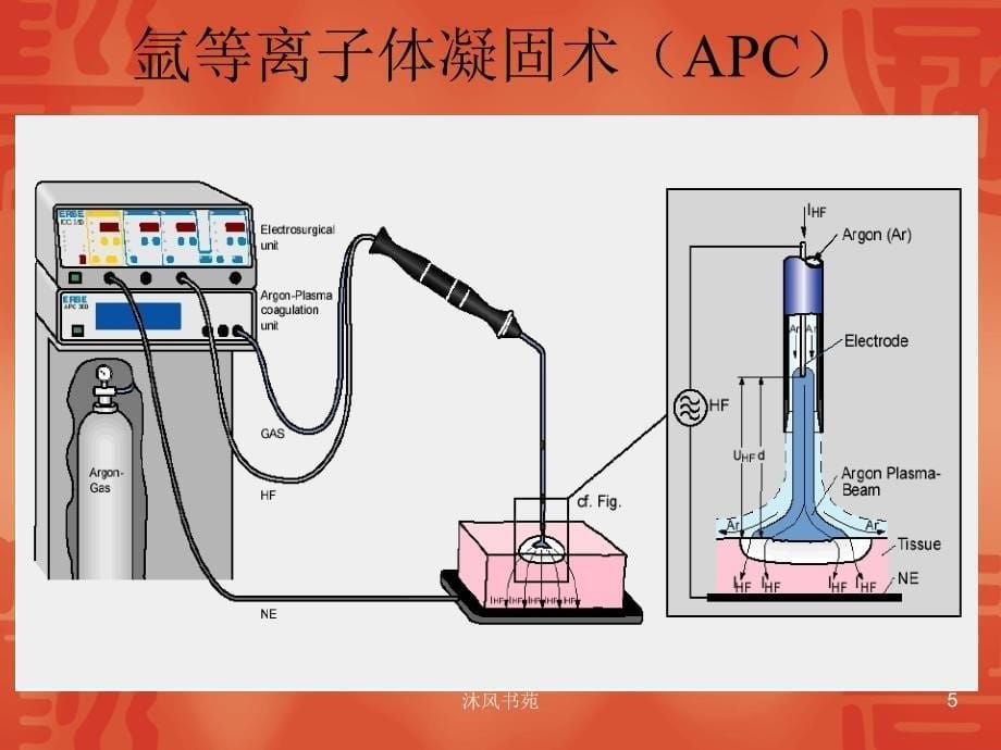 支气管镜下气道腔内疾病的介入治疗(APC、冷冻)【应用材料】_第5页