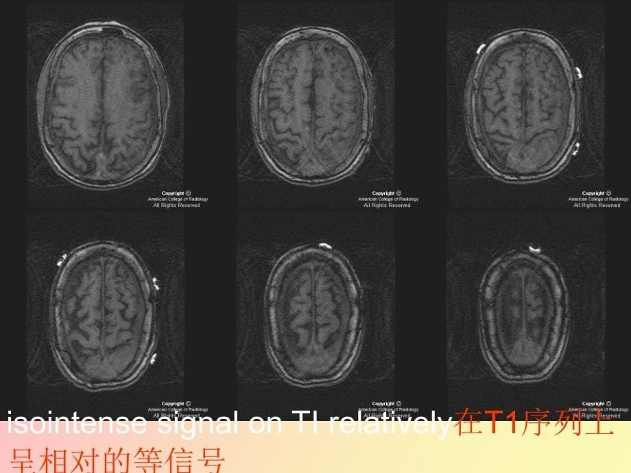 硬膜浆细胞瘤的MR诊断_第5页