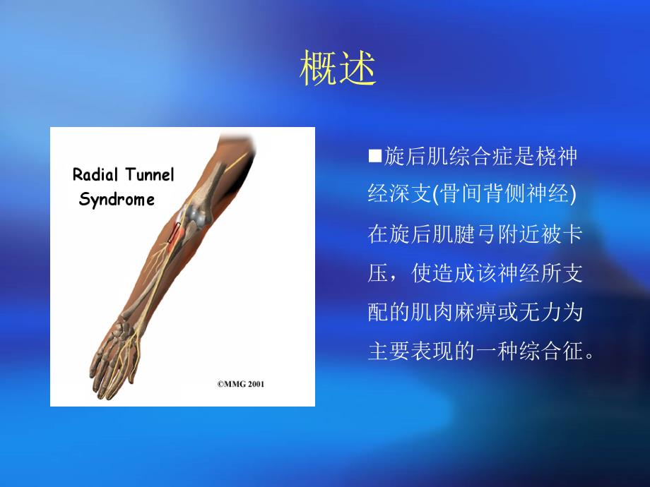 旋前圆肌综合症(精).ppt_第2页