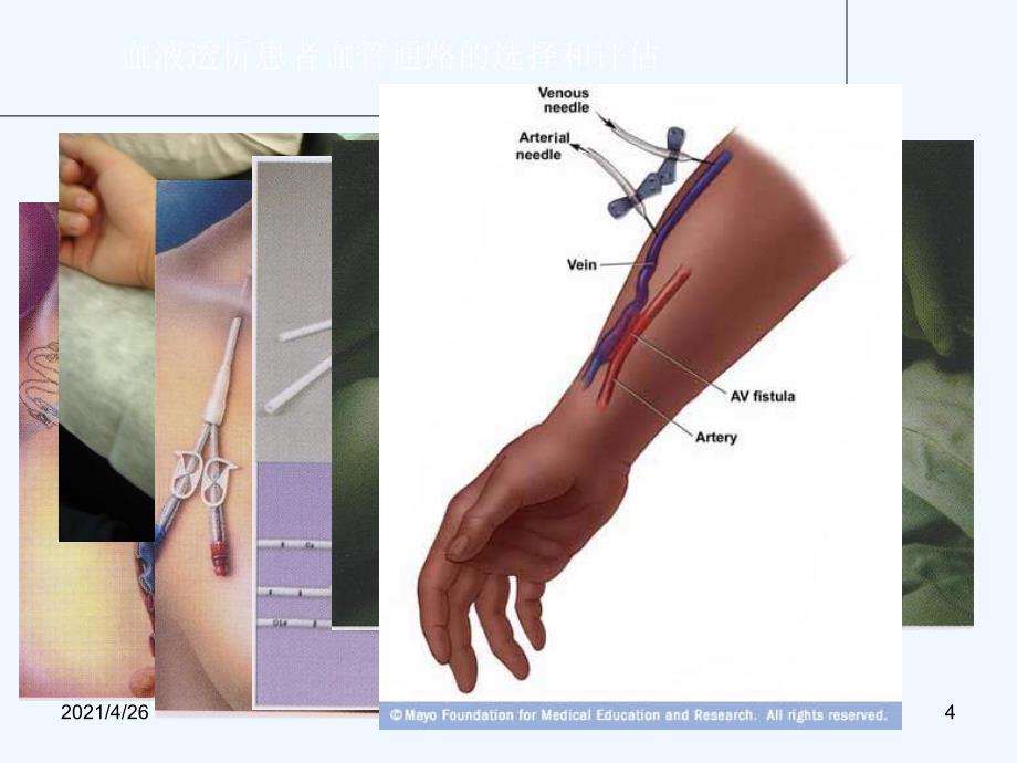 维持性血液透析患者血管通路的选择和评估_第4页