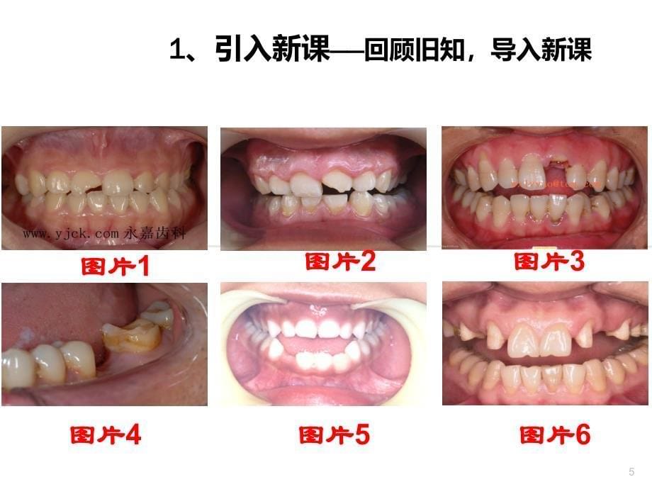 牙列缺损分类(可摘)_第5页