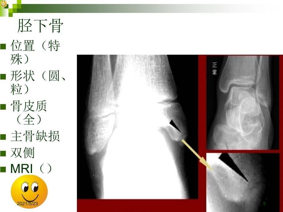 踝部常见损伤影像诊断_第5页