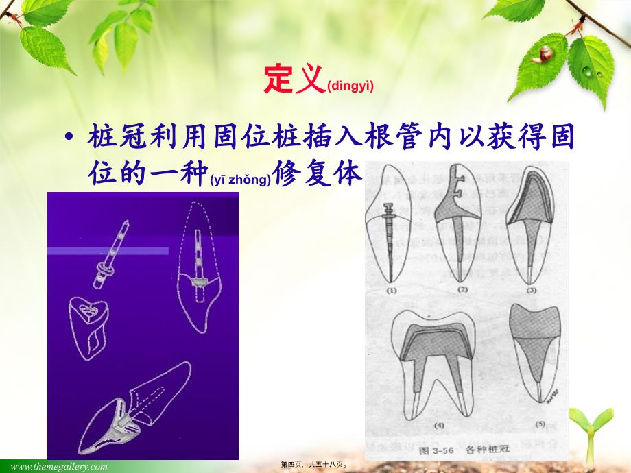 医学专题—口腔修复学第四章-桩核冠16839_第4页