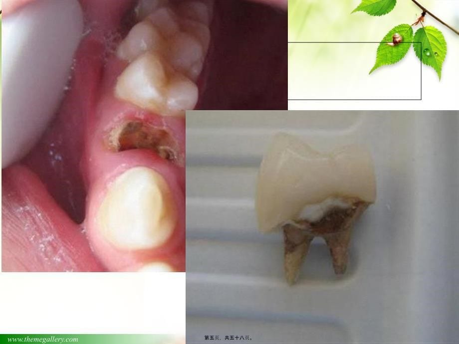 医学专题—口腔修复学第四章-桩核冠16839_第5页