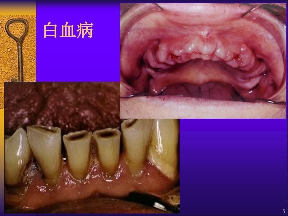 全身系统性疾病在口腔的表现_第5页