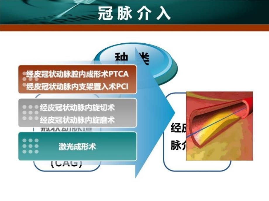 最新心内科介入治疗ppt课件PPT课件_第4页