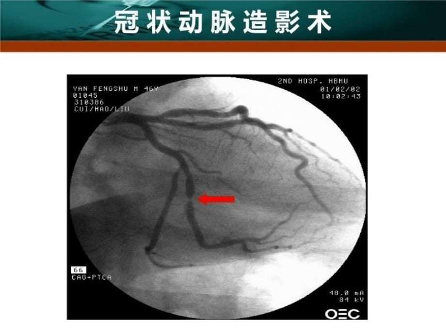 最新心内科介入治疗ppt课件PPT课件_第5页