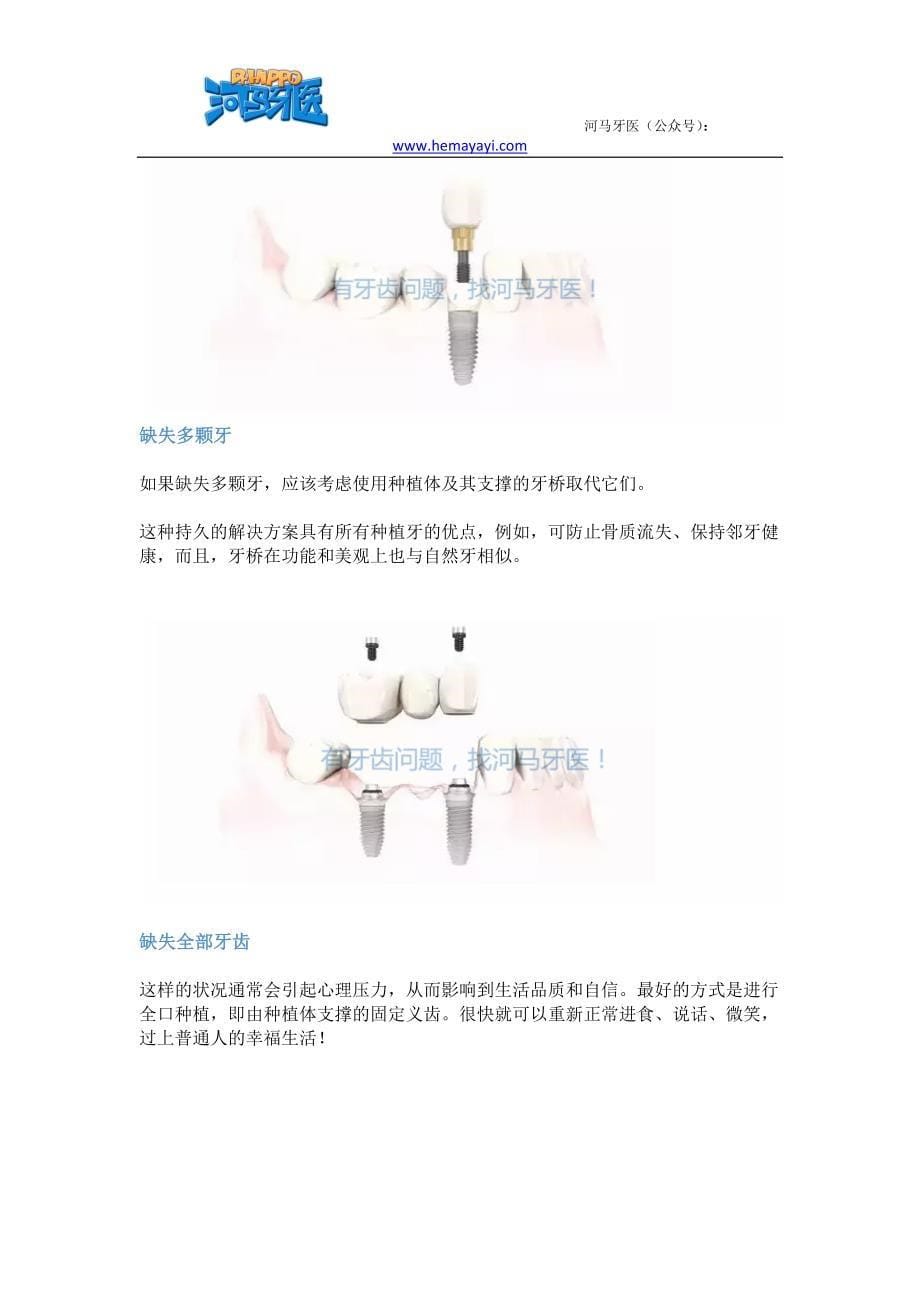 种植牙能用多久.docx_第5页