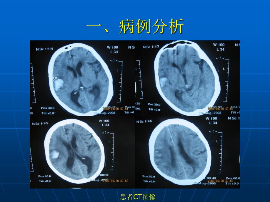 脑淀粉样血管病课件_第3页