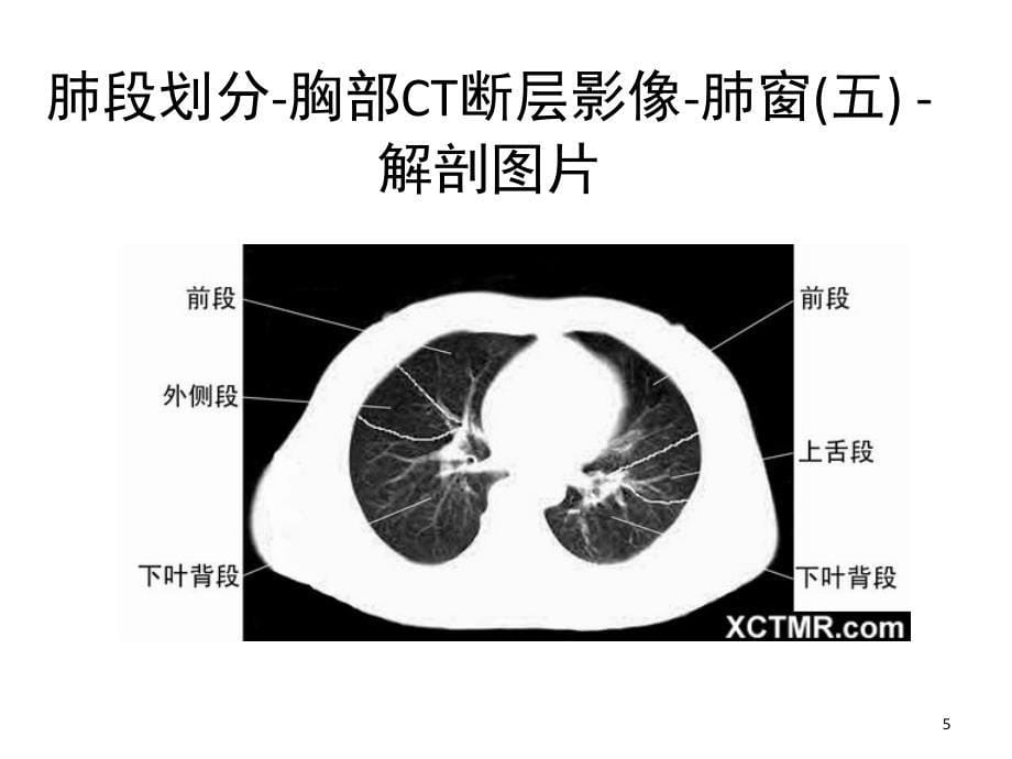 胸部CT肺段划分课堂PPT_第5页