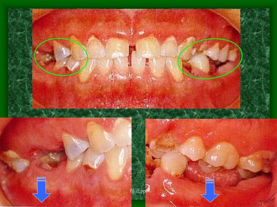 龋病详解及图库1_第4页